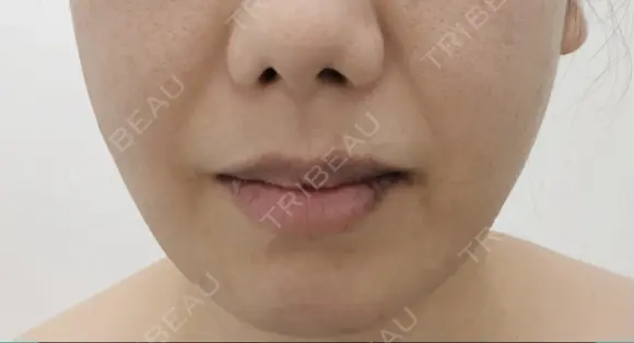 糸リフト EMMA CLINIC（エマクリニック） BEFORE メイン用
