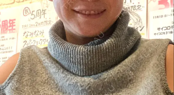 切開リフト / ボトックス（エラ・小顔） 石倉クリニック 水戸院 BEFORE メイン用