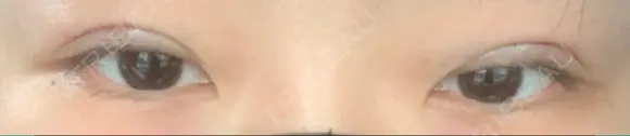 二重切開 / 上まぶたの脂肪取り たにまちクリニック BEFORE メイン用