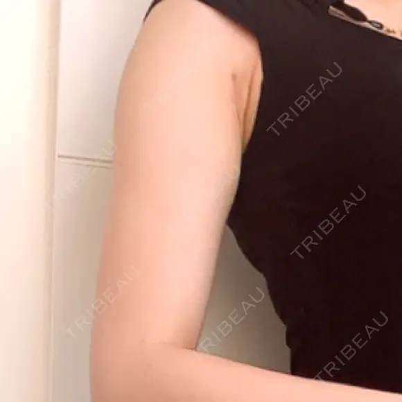 脂肪吸引（二の腕） / その他（ボディ） 銀座マイアミ美容外科 BEFORE メイン用