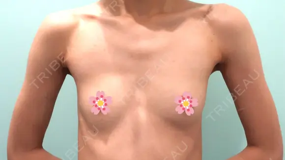 豊胸（ヒアルロン酸） WOM CLINIC GINZA （ワム クリニック ギンザ） BEFORE メイン用