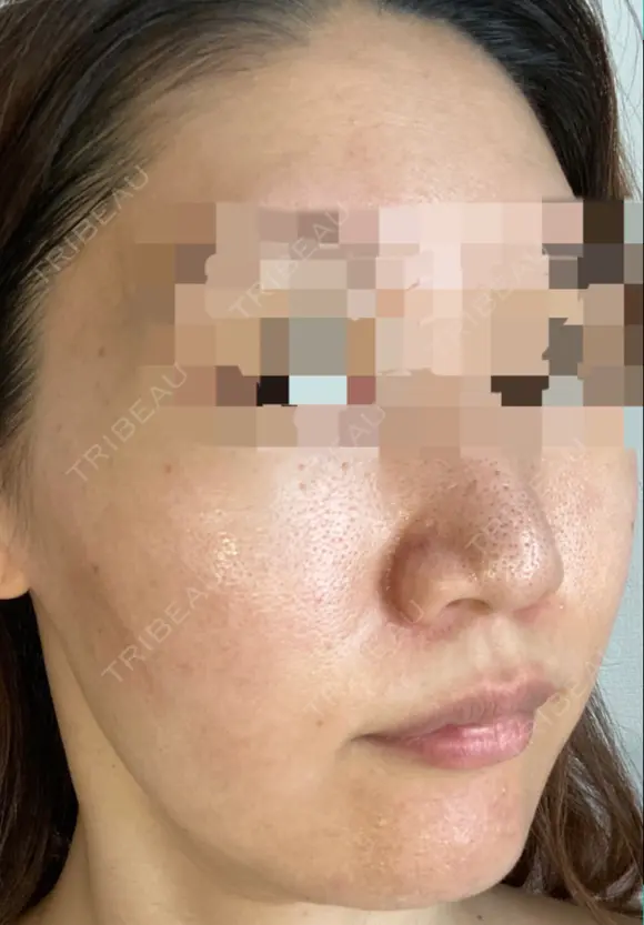 ダーマペン / 毛穴洗浄（ハイドラフェイシャルなど） AURORA CLINIC（オーロラクリニック）新宿院 BEFORE メイン用