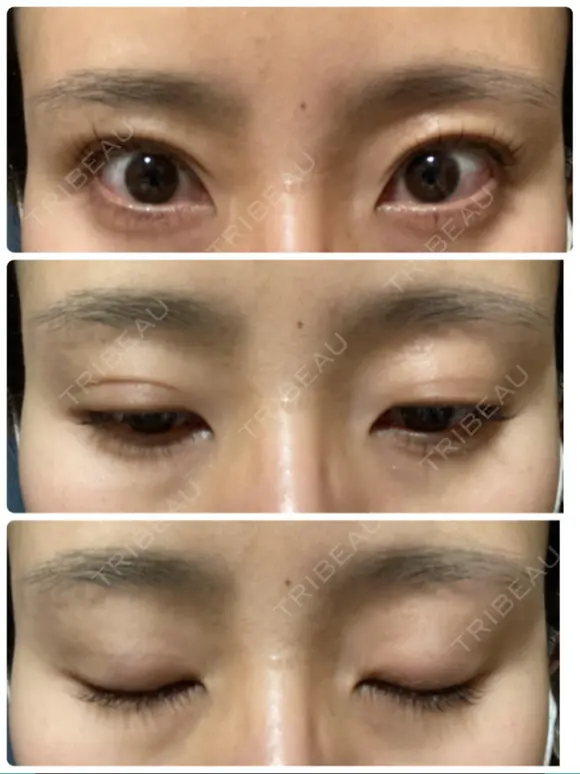 二重埋没 オジスキンクリニック BEFORE メイン用