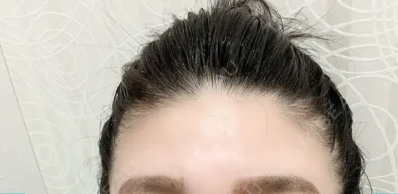 額を丸く / シワ取りボトックス / その他（肌） / その他（輪郭） 湘南美容クリニック 藤沢院 BEFORE メイン用