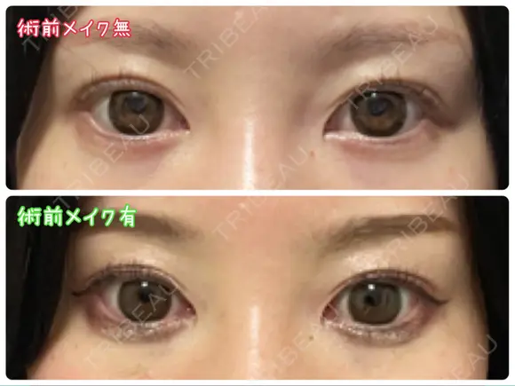 蒙古ひだ形成 R.O.clinic BEFORE メイン用