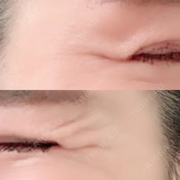 シワ取りボトックス 湘南美容クリニック 藤沢院 BEFORE メイン用