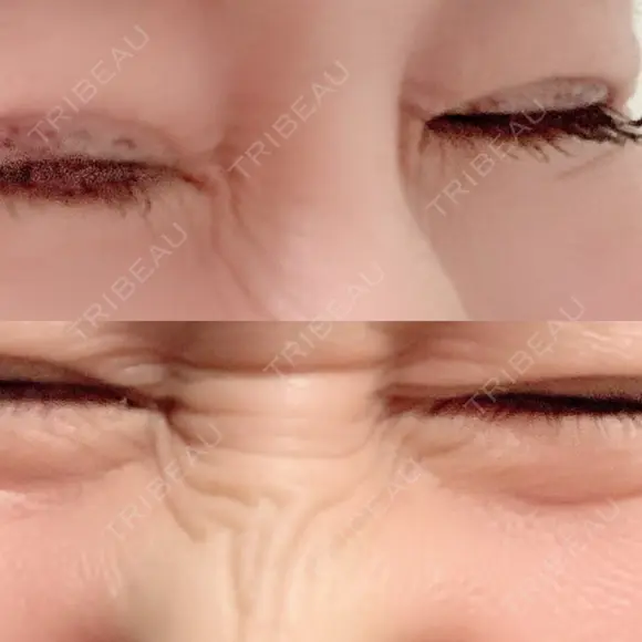 シワ取りボトックス 湘南美容クリニック 藤沢院 BEFORE メイン用