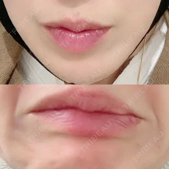 シワ取りボトックス 湘南美容クリニック 藤沢院 BEFORE メイン用