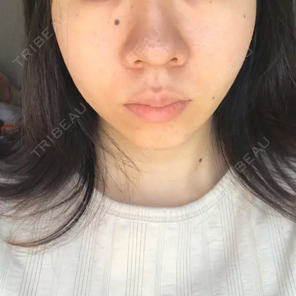 エレクトロポレーション / 毛穴洗浄（ハイドラフェイシャルなど） AURORA CLINIC（オーロラクリニック）新宿院 BEFORE メイン用