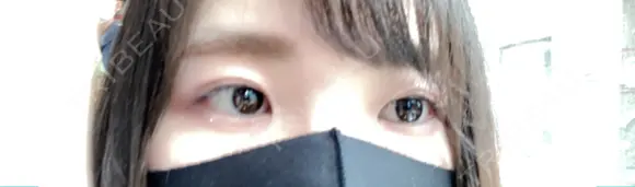 二重切開 松下皮フ形成外科 BEFORE メイン用