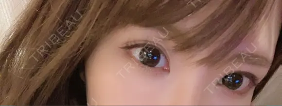 ヒアルロン酸注入（涙袋） アクトリー勝どきウェルネスメディカルクリニック BEFORE メイン用