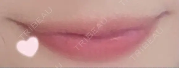 ヒアルロン酸注入（唇） / ボトックス（口角） フィラークリニック 大阪心斎橋院 BEFORE メイン用