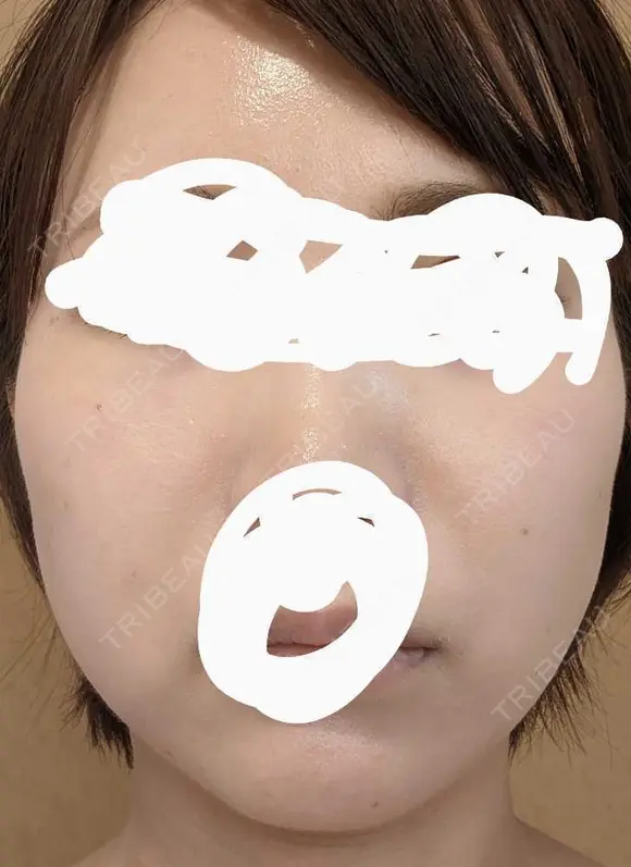 ボトックス（エラ・小顔） 湘南美容クリニック 静岡院 BEFORE メイン用