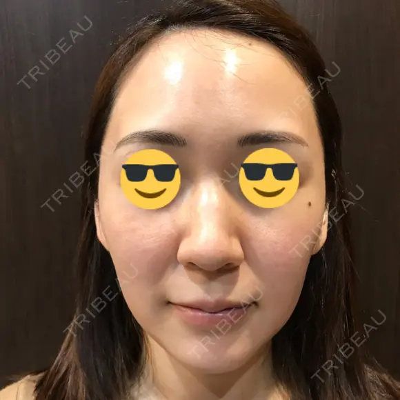 ダーマペン AURORA CLINIC（オーロラクリニック）新宿院 BEFORE メイン用