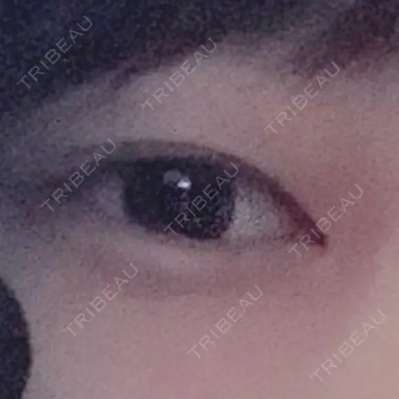 二重切開 / 上まぶたの脂肪取り 松下皮フ形成外科 BEFORE メイン用