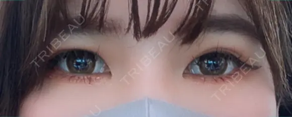 二重切開 松下皮フ形成外科 BEFORE メイン用