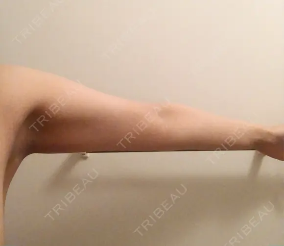 脂肪吸引（二の腕） 銀座マイアミ美容外科 BEFORE メイン用