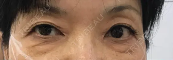 下まぶたたるみ取り / 下まぶたの脂肪取り / 美容点滴・美容注射（美肌） / 白玉点滴・注射 キップン整形外科 BEFORE メイン用