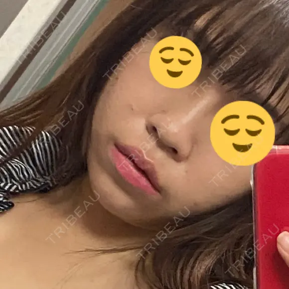 脂肪吸引（顔） ルラ美容クリニック 渋谷本院 BEFORE メイン用