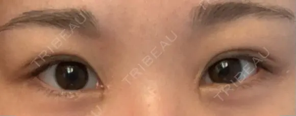 目尻切開 / タレ目形成・グラマラスライン（切開） / 目尻靭帯移動 アネシス美容クリニック BEFORE メイン用