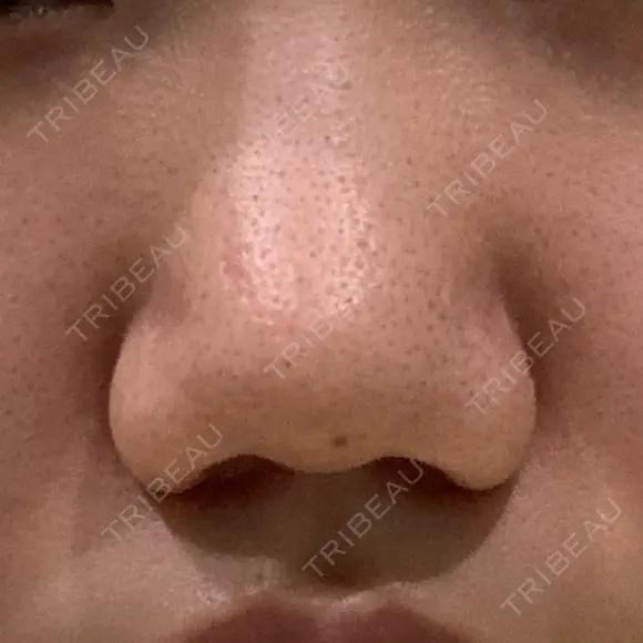 小鼻縮小（切開） / 鼻翼挙上 / 鼻孔縁挙上 くさのたろうクリニック BEFORE メイン用