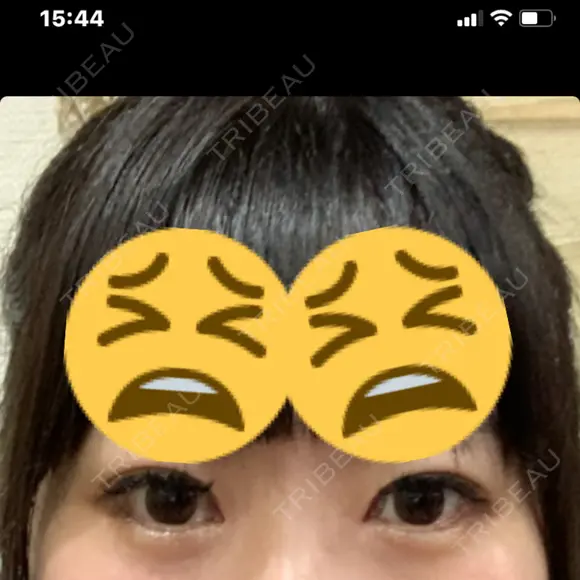 二重埋没 TCB東京中央美容外科 心斎橋筋院 BEFORE メイン用