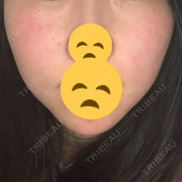 レーザートーニング（美白・肝斑） R.O.clinic BEFORE メイン用