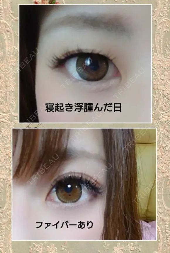 二重埋没 品川美容外科 福岡院 BEFORE メイン用