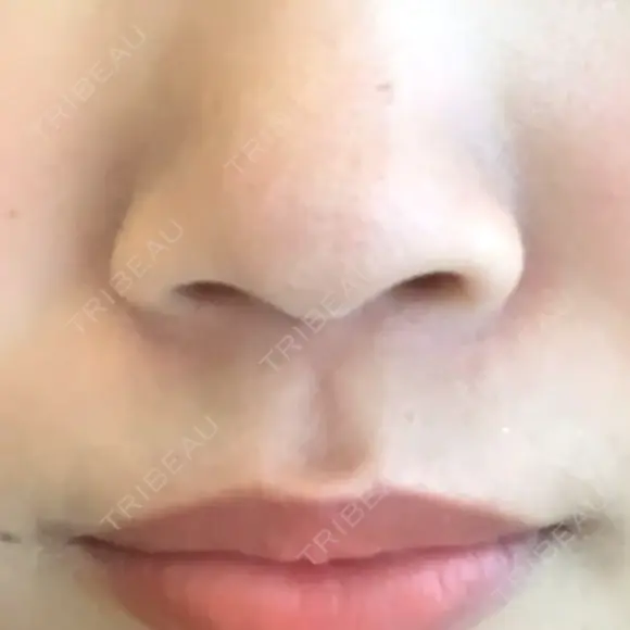 鼻尖形成（切開） / ヒアルロン酸注入（鼻） / ヒアルロン酸注入（あご） 東京ヒルズクリニック 新宿院 BEFORE メイン用