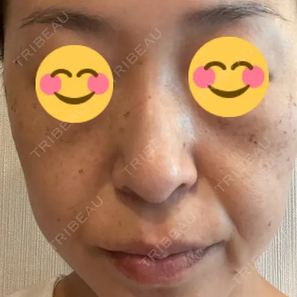 プラセンタ注射 / ピーリング（ニキビ・毛穴） / イオン導入 / シミ取りレーザー ナチュラルハーモニークリニック表参道 BEFORE メイン用