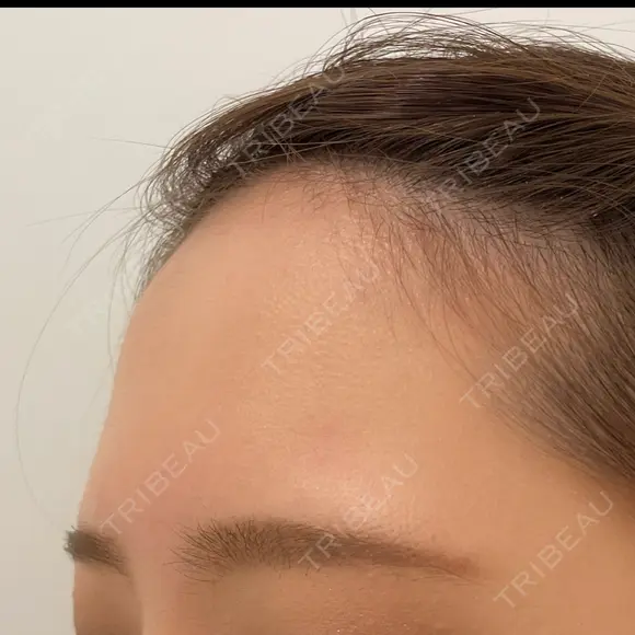 額を丸く / ヒアルロン酸注入（額） 藤・ナチュレ美容クリニック 恵比寿院 BEFORE メイン用