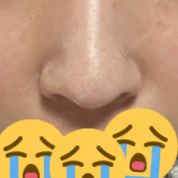 鼻尖形成（切開） / ヒアルロン酸注入（鼻） 東京ヒルズクリニック 岡崎院 BEFORE メイン用