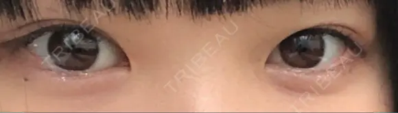 二重切開 松下皮フ形成外科 BEFORE メイン用