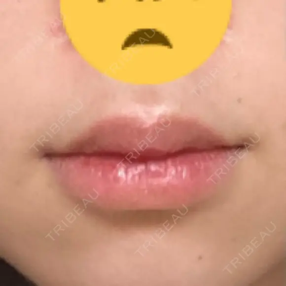 口唇縮小術 B-LINE CLINIC 池袋院 BEFORE メイン用