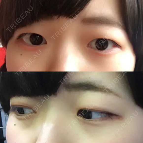 二重切開 松下皮フ形成外科 BEFORE メイン用