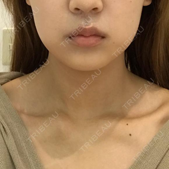 脂肪溶解注射（顔） 有楽町美容外科クリニック BEFORE メイン用