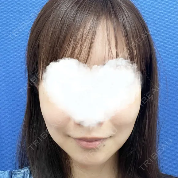 糸リフト 湘南美容クリニック 岡山院 BEFORE メイン用