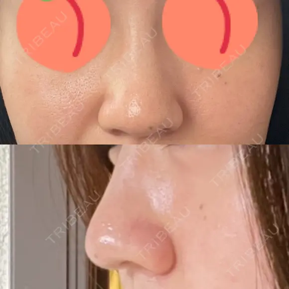 鼻尖形成（切開） / 鼻尖縮小 / その他（鼻） 聖心美容クリニック 札幌院 BEFORE メイン用