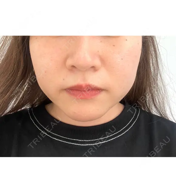 バッカルファット除去 / 脂肪吸引（顔） EMMA CLINIC（エマクリニック） BEFORE メイン用