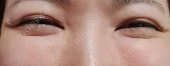 その他（目元） CLASSY 仙台美容外科・美容皮膚科 BEFORE メイン用