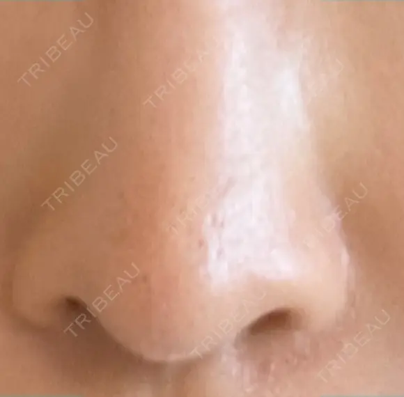フラクショナルレーザー（毛穴・ニキビ跡） PICO BEAUTY CLINIC BEFORE メイン用