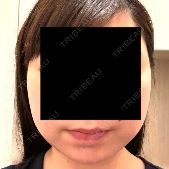 糸リフト / 脂肪吸引（顔） / ボトックス（エラ・小顔） / その他（肌） A CLINIC（エークリニック） 銀座院 BEFORE メイン用