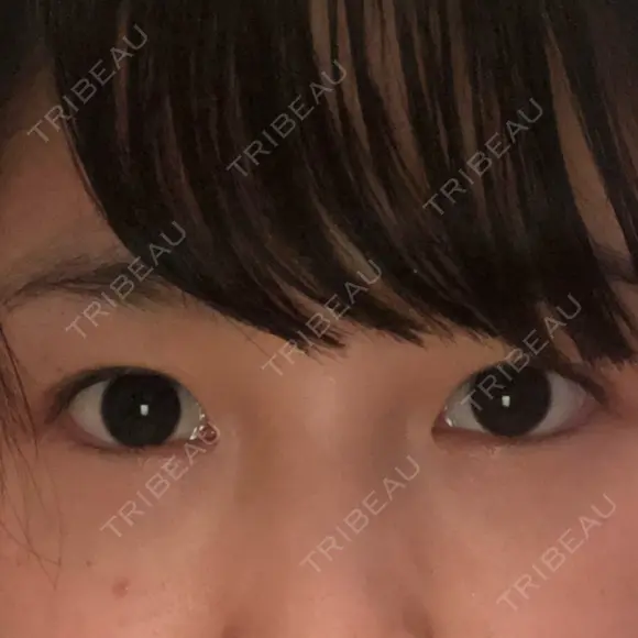 二重埋没 / 目頭切開 / 上まぶたの脂肪取り 湘南美容クリニック 柏院 BEFORE メイン用
