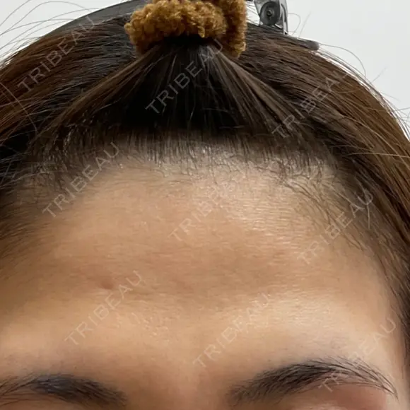 ボトックス（額） / 再生医療 クリニックビューティー恵比寿 BEFORE メイン用