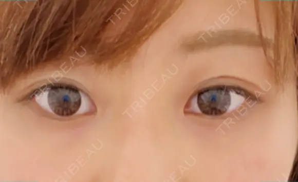 二重切開 / 目頭切開 / 目尻切開 / 下まぶたの脂肪取り 湘南美容クリニック 新宿本院 BEFORE メイン用