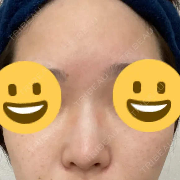 隆鼻術 サラ美容外科 BEFORE メイン用