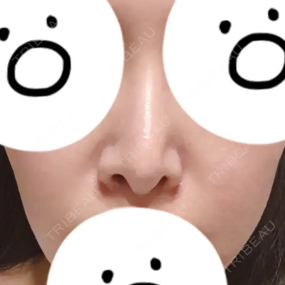 隆鼻術 / 鼻中隔延長（切開） / 小鼻縮小（切開） / 軟骨移植 / 鼻修正 / 鼻孔縁下降 FROM B整形外科 (旧バウム整形外科) BEFORE メイン用