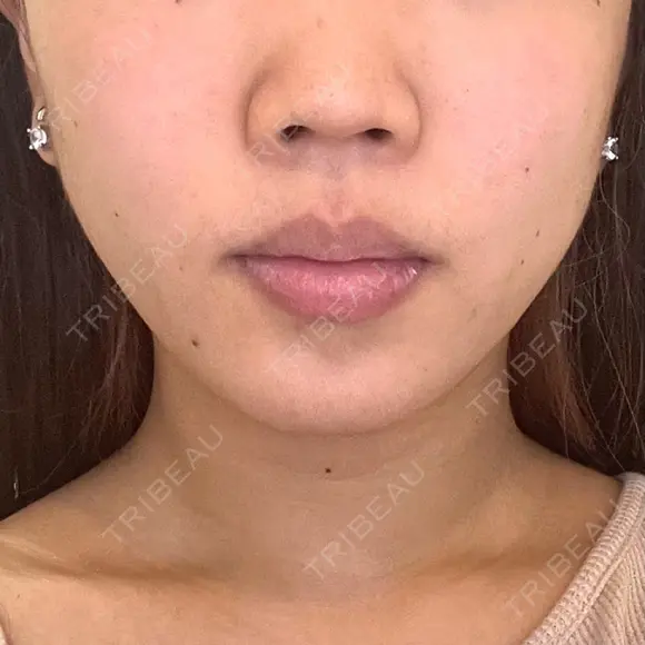 小鼻縮小（切開） / 口唇縮小術 / 口角挙上 / その他（鼻） / その他（口元） B-LINE CLINIC 池袋院 BEFORE メイン用