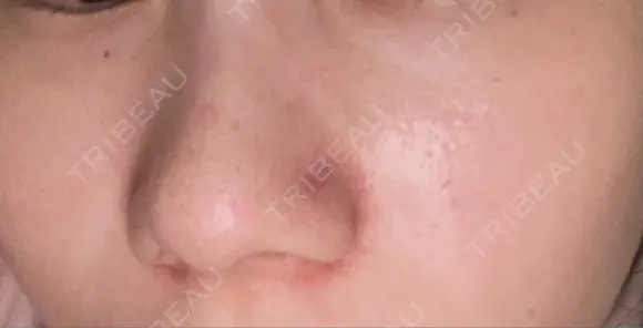 毛穴洗浄（ハイドラフェイシャルなど） TRUE DESIGN CLINIC BEFORE メイン用