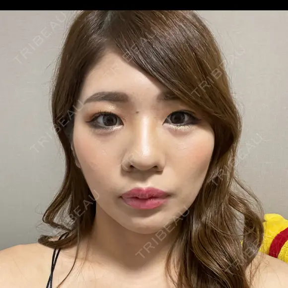 鼻尖形成（切開） / 鼻中隔延長（切開） / 小鼻縮小（切開） / 骨切幅寄せ / ワシ鼻修正・ハンプ切除 / 脂肪注入（額） Zetith Beauty Clinic 銀座院 BEFORE メイン用